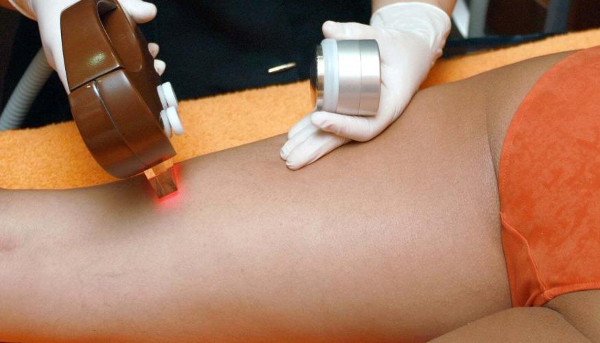 Épilation Lumière Pulsée