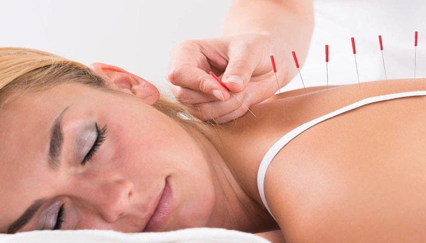 Akupunktur