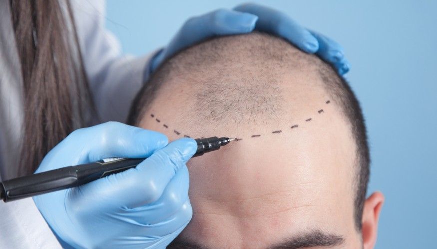 Haartransplantation